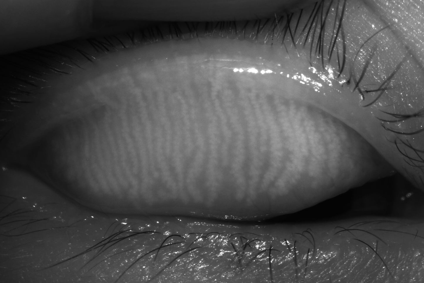 DA-2 Dry Eye Analyzer - OcuRx