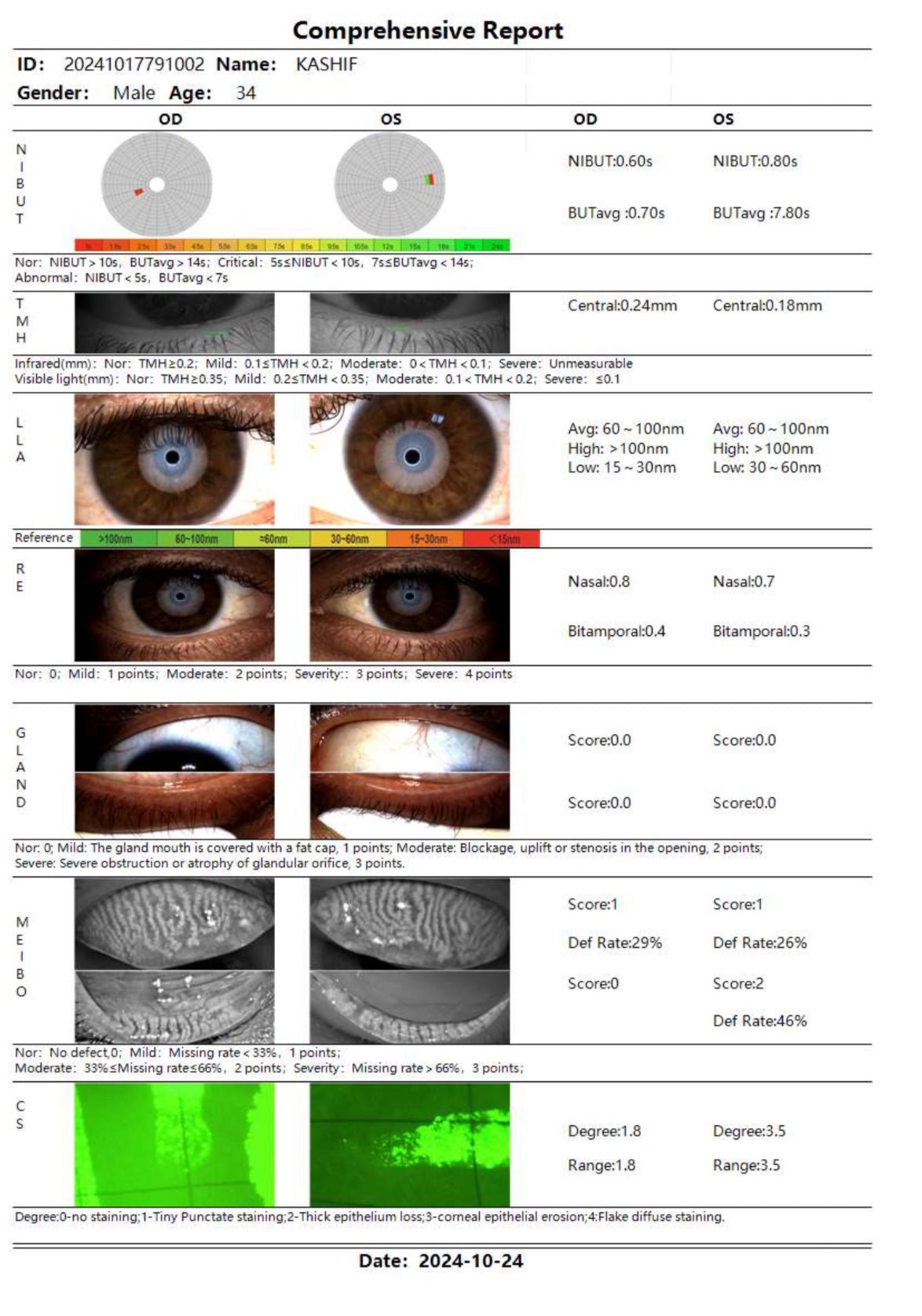 DA-2 Dry Eye Analyzer - OcuRx