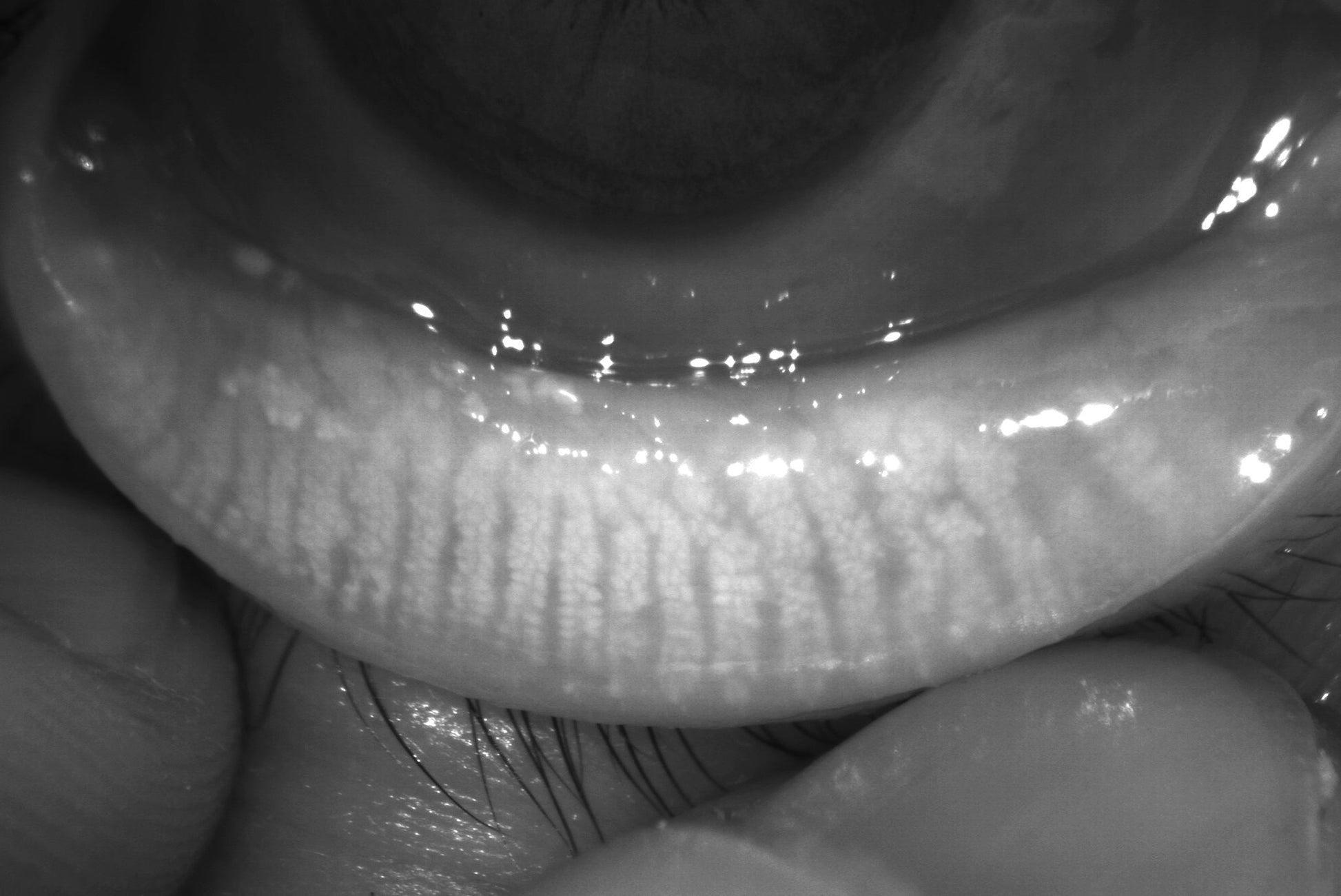 DA-2 Dry Eye Analyzer - OcuRx