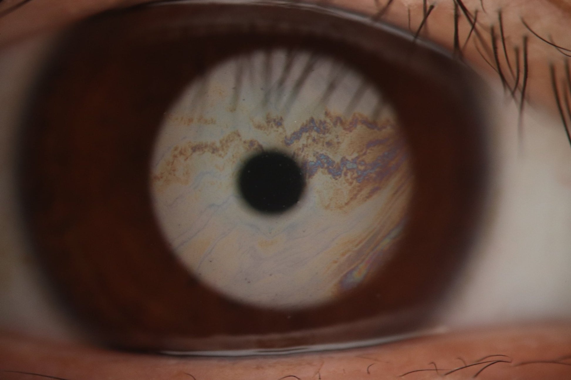 DA-2 Dry Eye Analyzer - OcuRx