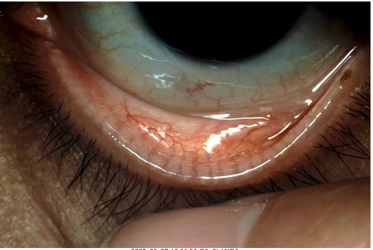 DA - 2 Dry Eye Analyzer - OcuRx