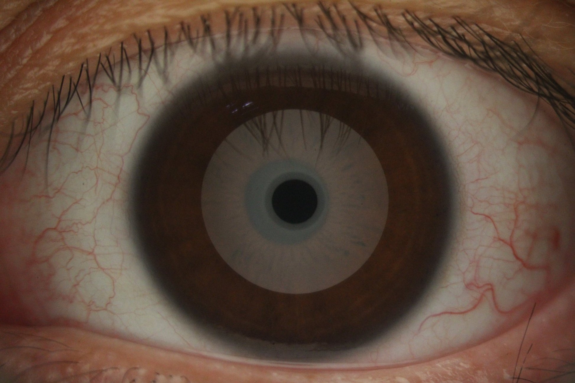 DA-2 Dry Eye Analyzer - OcuRx