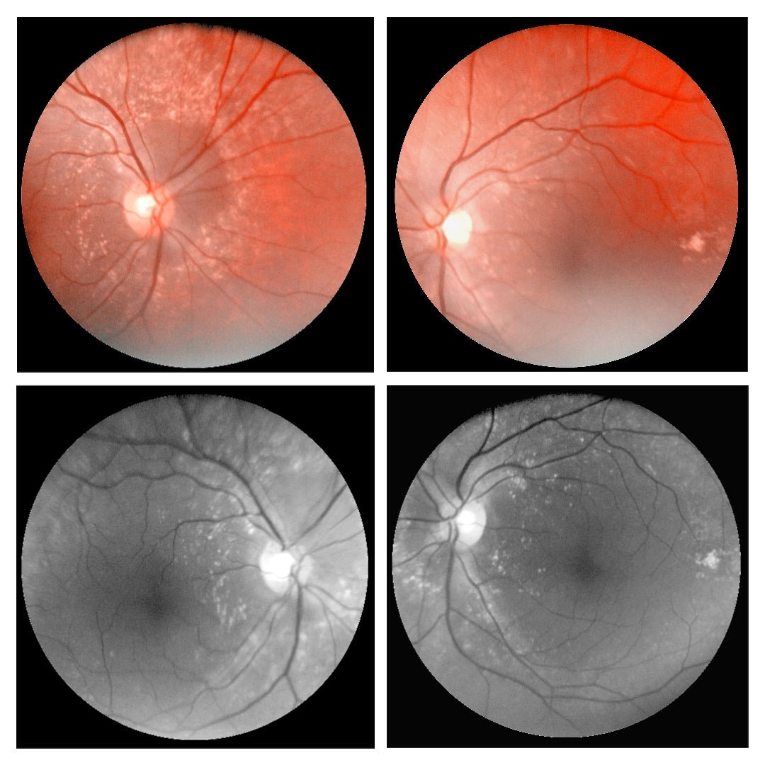 OcuRx Fundus Camera Portable - OcuRx