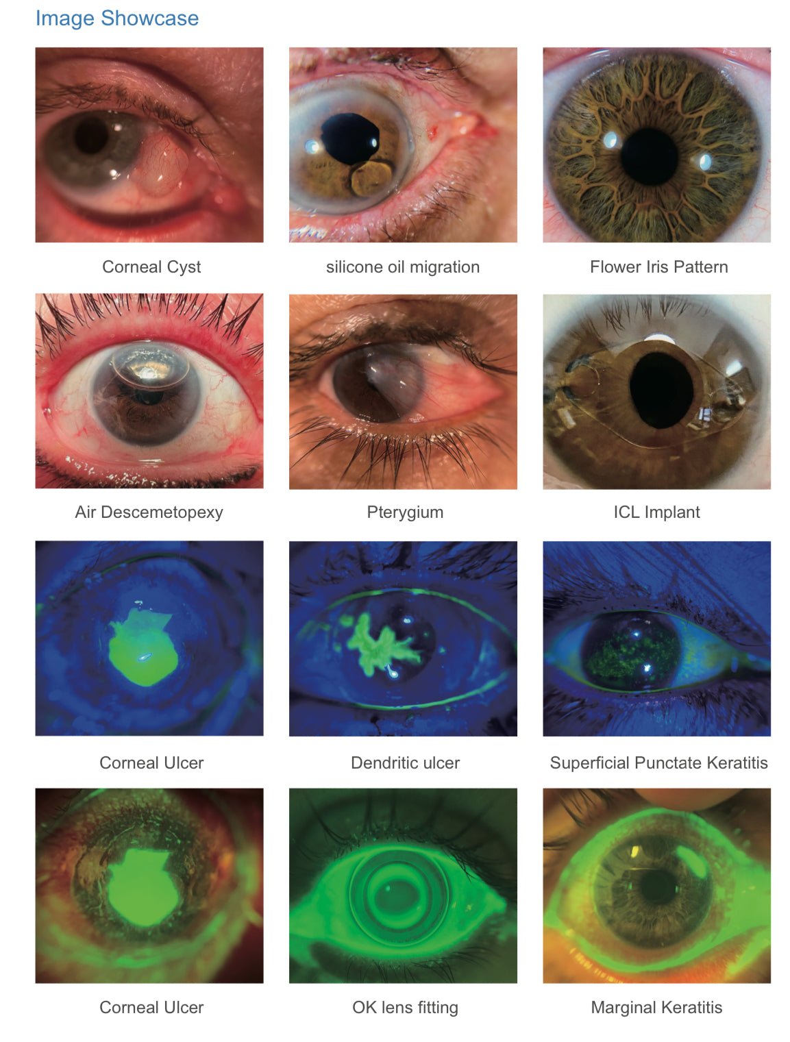 QuikVue Plus - OcuRx