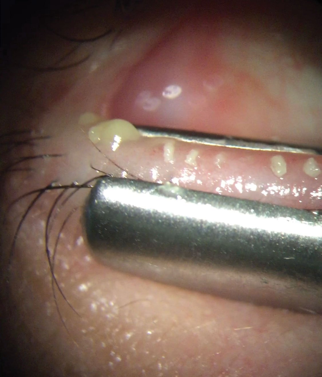 Stainless Steel Meibomian Gland Forceps - OcuRx