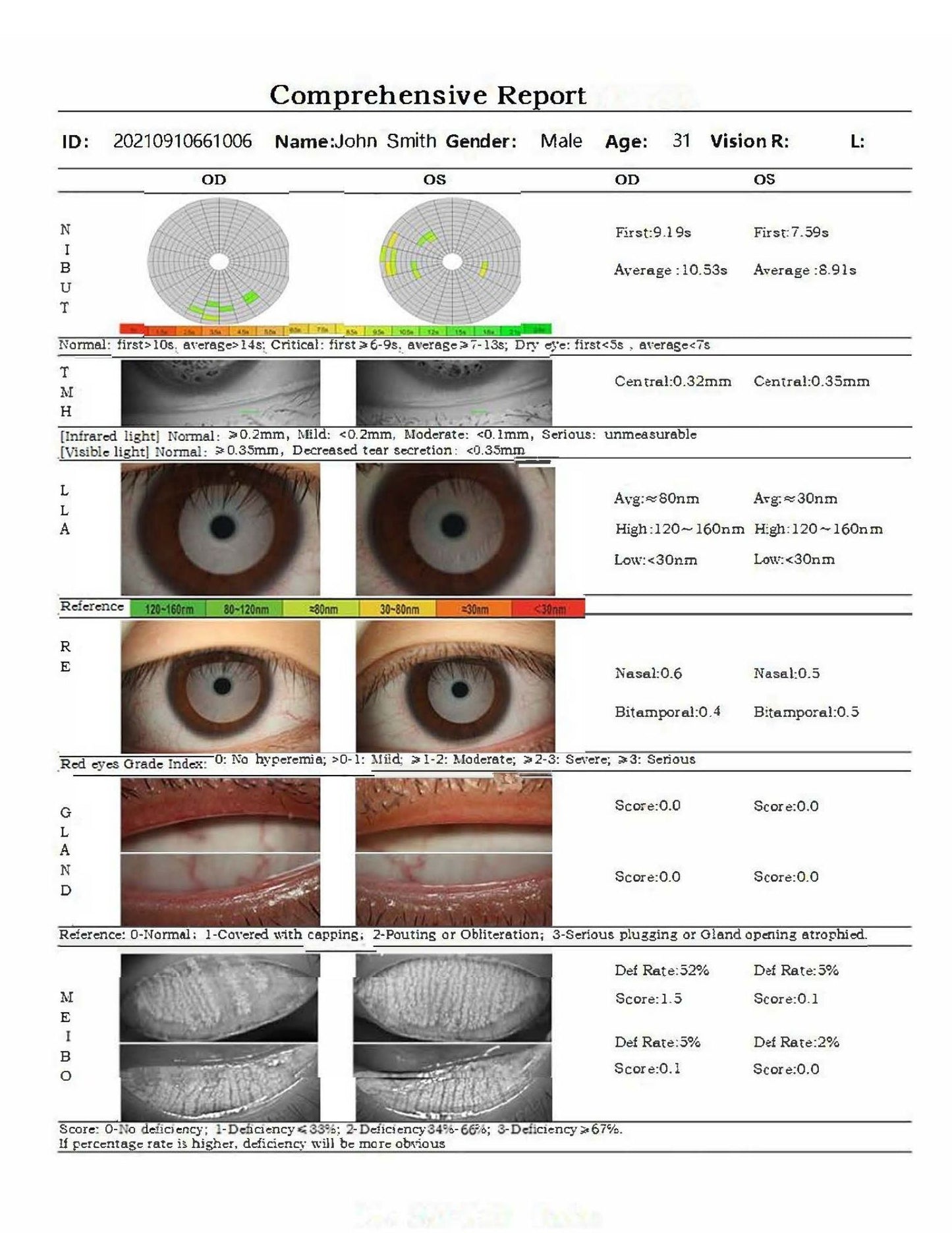 DA-3 Dry Eye Analyzer