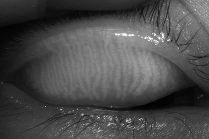 DA-2 Dry Eye Analyzer - OcuRx