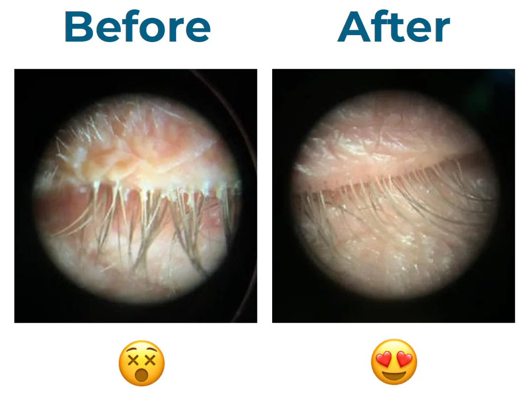 NULIDS Pro System for Dry Eyes | Gentle Lid Hygiene & Blepharitis Relief - OcuRx